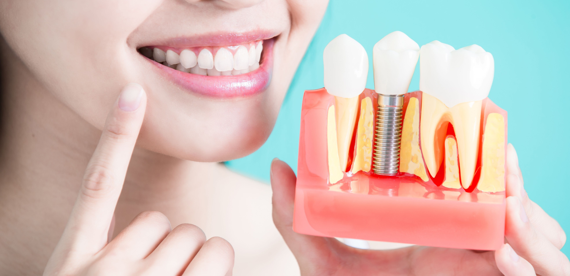 الفوائد الطبية لزراعة الأسنان